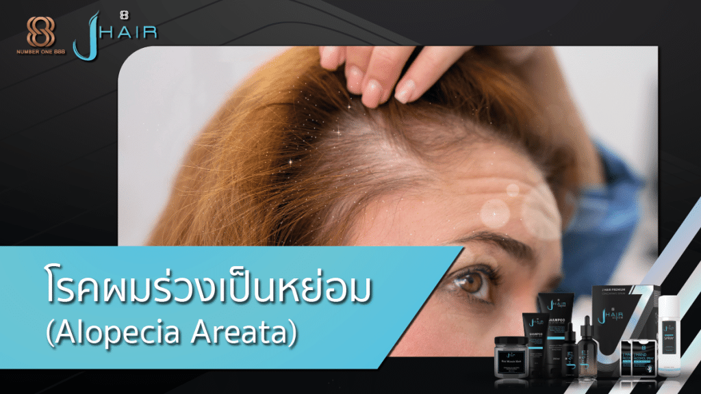 โรคผมร่วงเป็นหย่อม (Alopecia Areata) การรักษาผมร่วง - JHair Serum