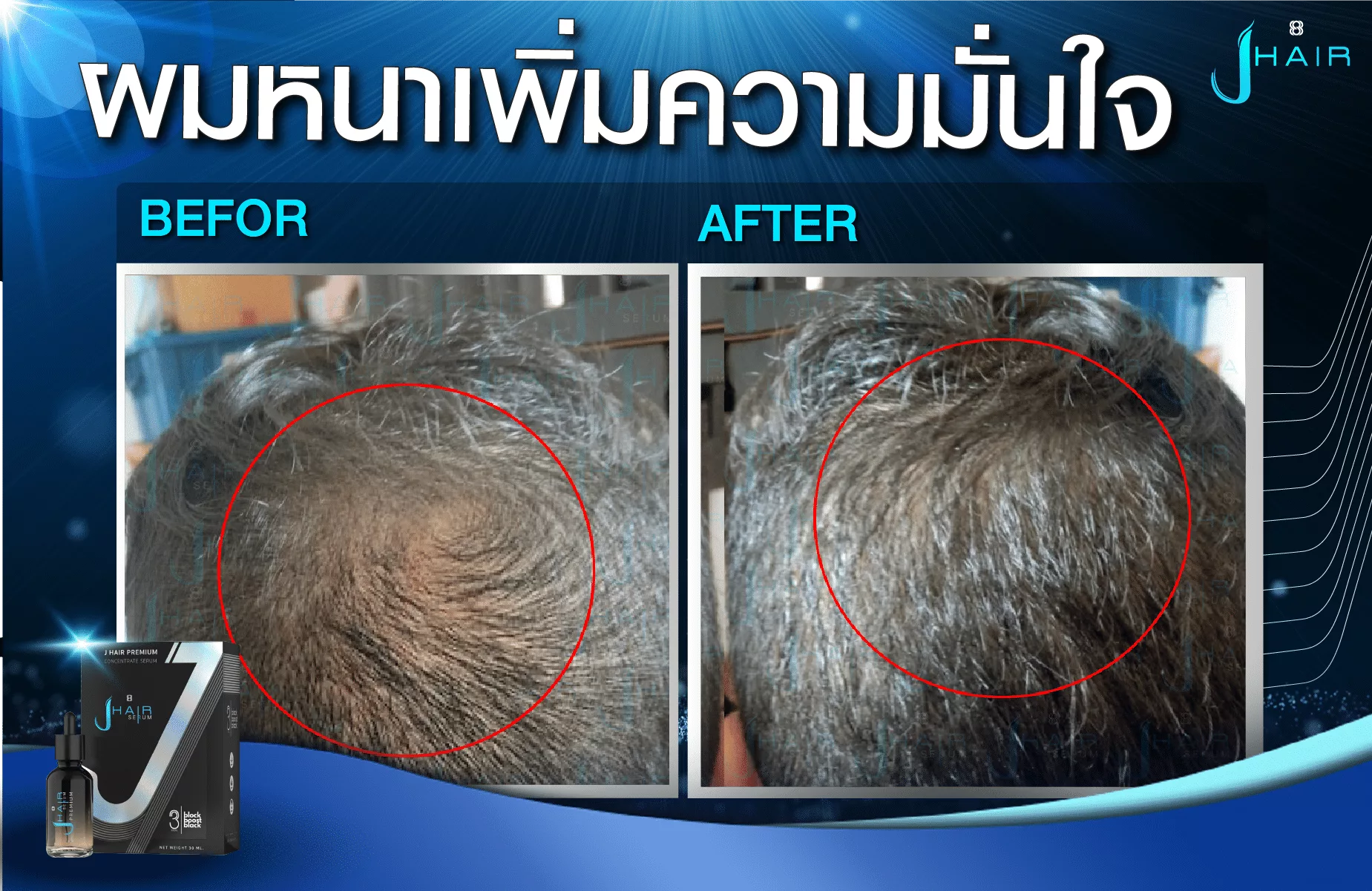 รีวิวจากผู้ใช้จริง J HAIR SERUM เซรั่มปลูกผม