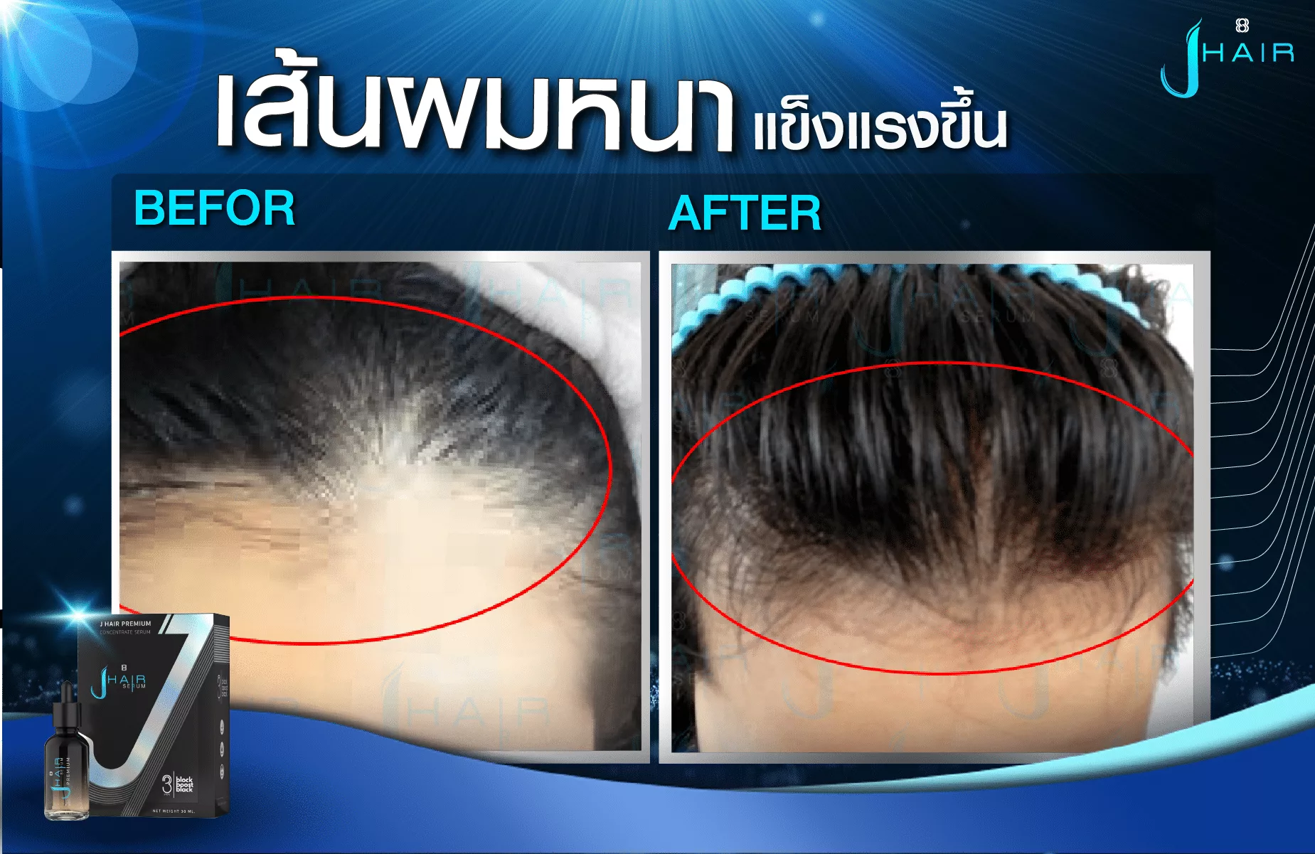 รีวิวจากผู้ใช้จริง J HAIR SERUM เซรั่มปลูกผม